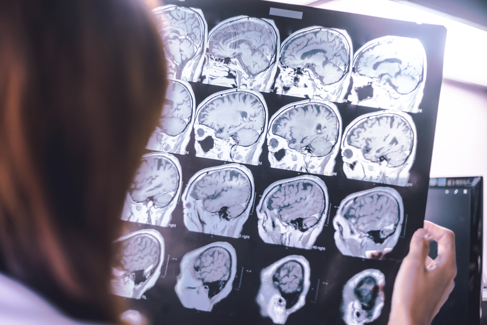 frontal lobe atrophy on MRI film
probably Frontotemporal Dementia
