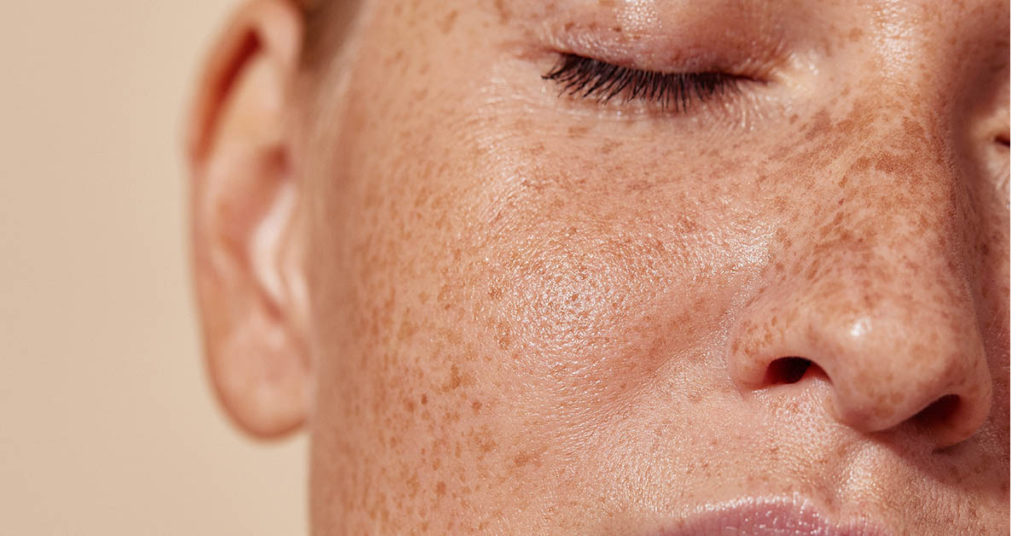 Young Woman Gets “Freckle Tattoos” and People As Saying it Will ‘Age Her Like a Tramp Stamp’ - Featured image