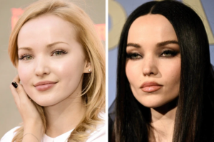 14 Famous People Before and After Cheekbone Surgery