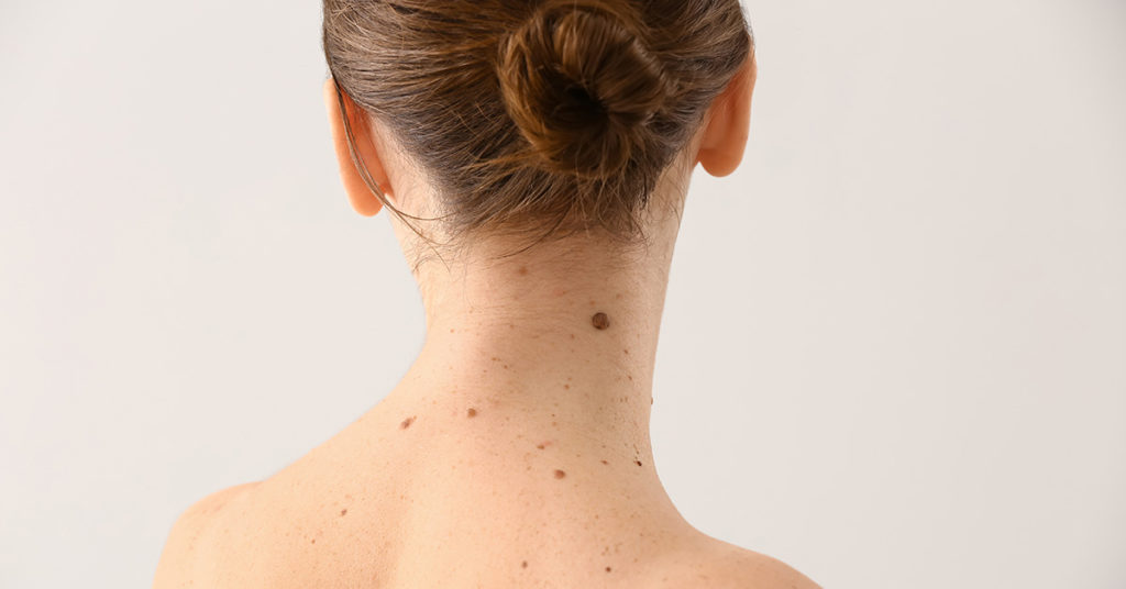 What Your Moles on Various Body Parts Could Be Telling You About Your Personality - Featured image