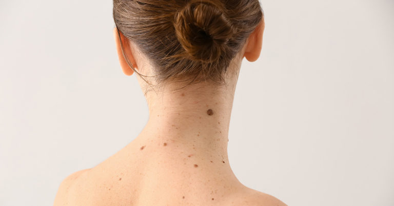 What Your Moles on Various Body Parts Could Be Telling You About Your Personality - Featured image
