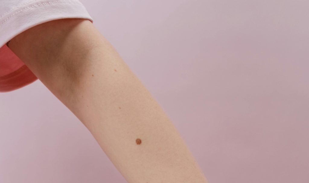 mole on arm