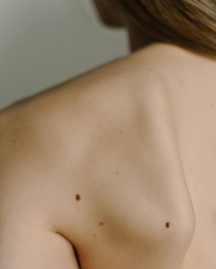 mole on shoulder, moles and personality traits