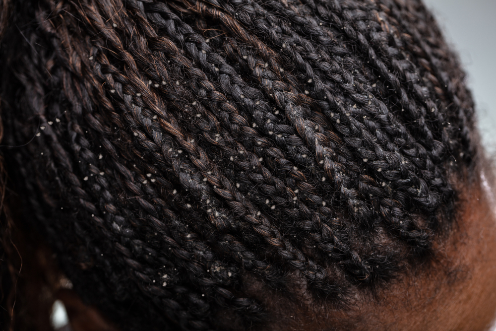 Close-up Photo Of Dandruff In Woman's Hair