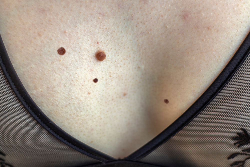 Close-up of female skin on chest with large moles.