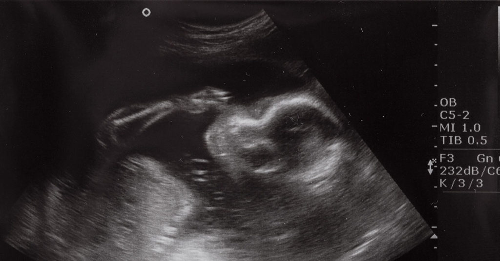 Mother’s Ultrasound Shows Baby ‘Blowing Bubbles’ Then Doctors Discovered What It Really Was - Featured image