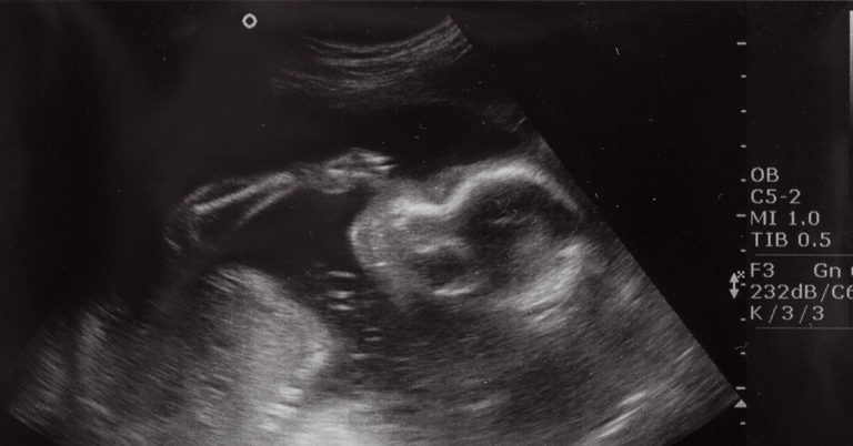 Mother’s Ultrasound Shows Baby ‘Blowing Bubbles’ Then Doctors Discovered What It Really Was - Featured image