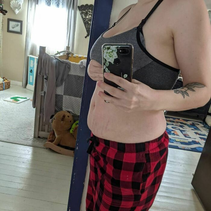 Stretch Marks as Symbols of Strength
