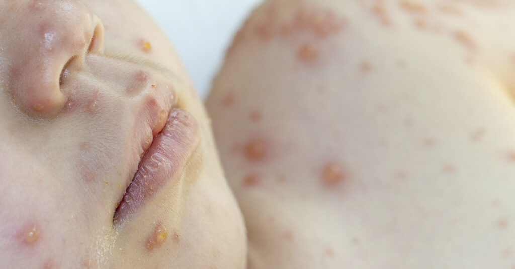 Why Does My Baby Have a Lip Blister? Causes, Remedies, and Guidance - Featured image