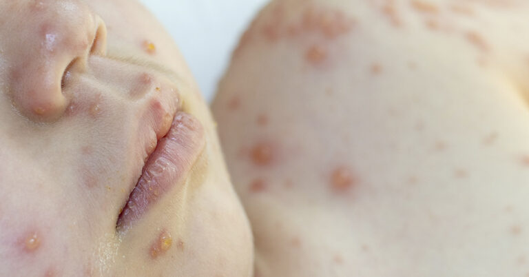 Why Does My Baby Have a Lip Blister? Causes, Remedies, and Guidance - Featured image