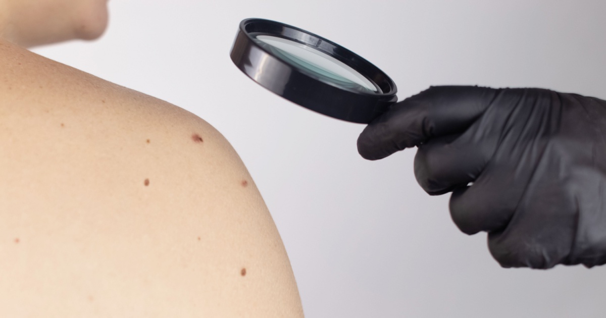 dermatologist appointment shows his birthmarks, moles and nevi. The doctor examines the patient with a dermatoscope. Benign and malignant birthmarks. Skin abnormalities care concept