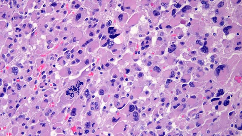 Microscopic view of adrenocortical carcinoma tissue cells stained purple and pink, revealing cellular changes typical of rare cancer symptoms at the histological level.