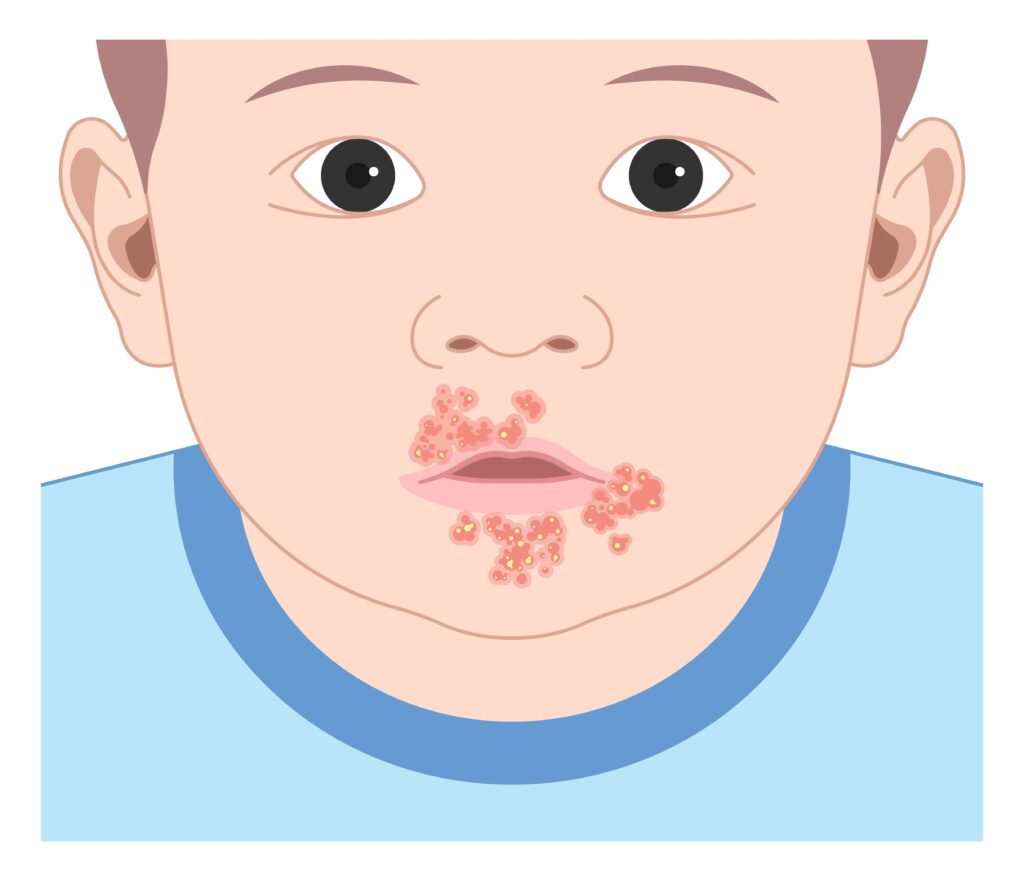 Impétigo, infección oral por hiedra venenosa, sepsis, bacteriano, niños, dermatitis, enfermedad, verrugas, virus VPH, ampollas, cara, acné, picazón, piel irritada, enrojecimiento, cáncer, úlcera bucal, viral, resfriado, herpes labial, sarpullido, nariz, bebé, lactante