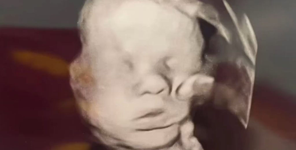 'hand of God' image seen in ultrasound