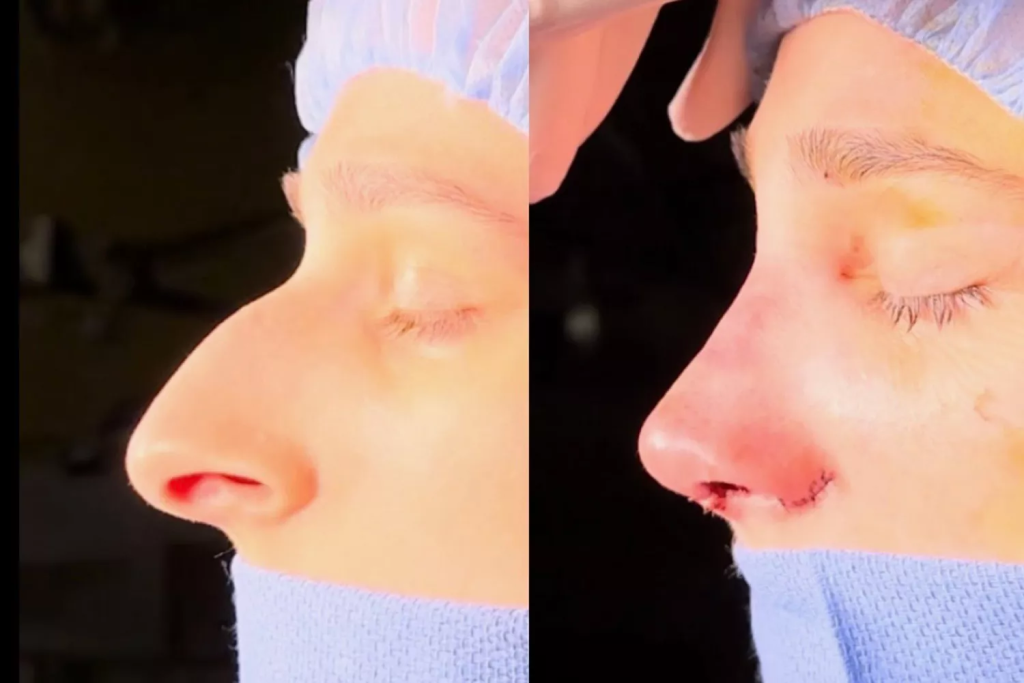 Devyn Aiken during and after her rhinoplasty.