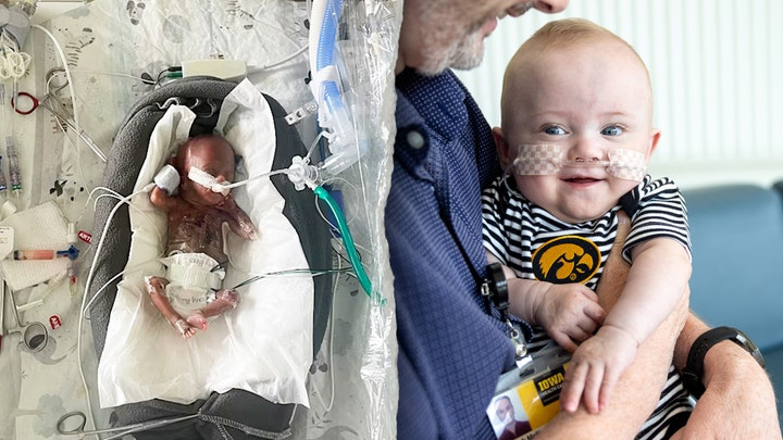 Two photos of Nash Keen, the most premature baby to survive: at left, at two weeks old in the NICU with breathing tube and medical equipment; at right, at 11 months old, healthy and smiling in a striped shirt.