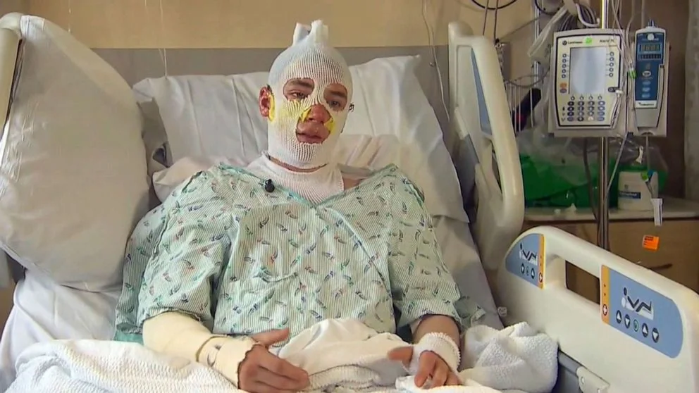 A person sits upright in a hospital bed with bandages covering most of their face and head.