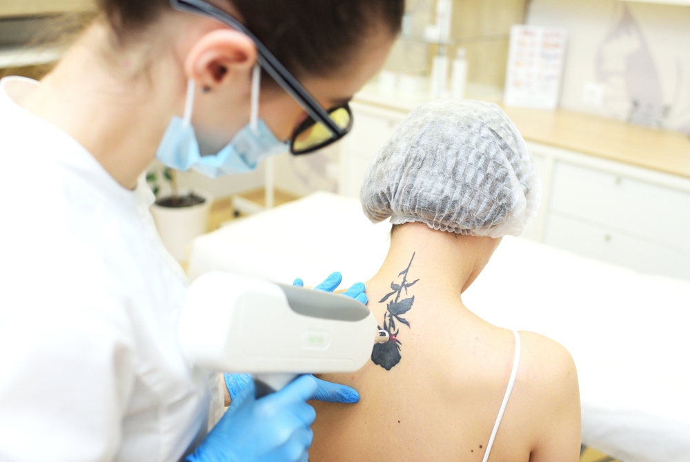 the cosmetologist removes the tattoo to the patient using a neodymium laser in a modern clinic. Hardware cosmetology