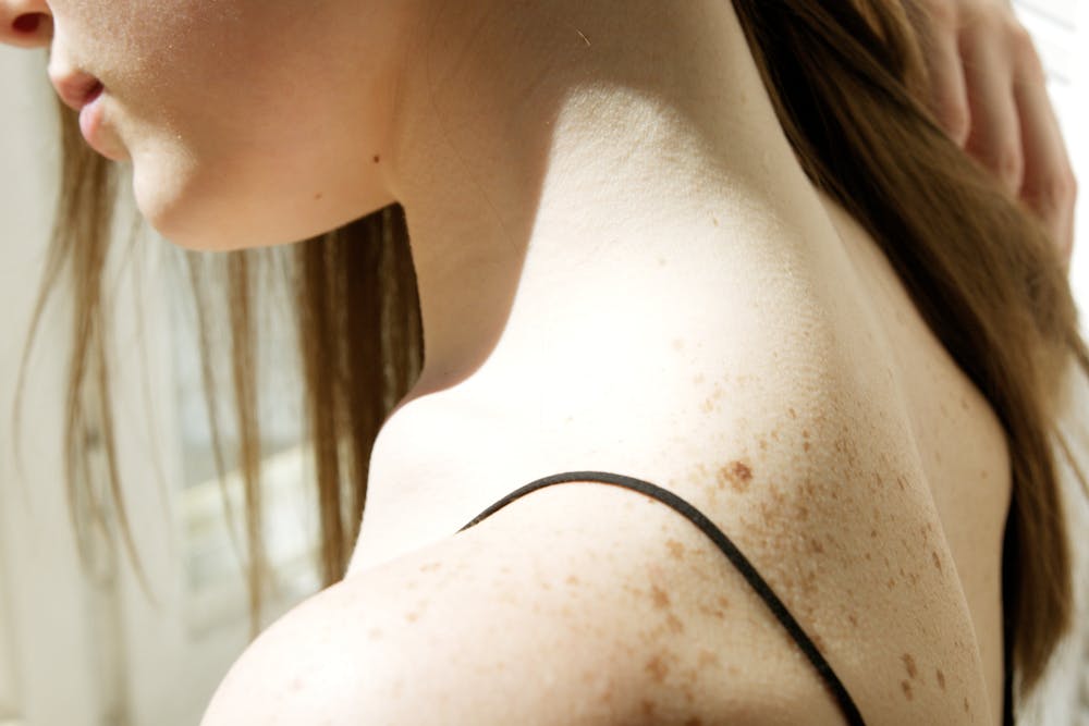 Why Experts Say You Should Never Remove a Skin Tag at Home - Featured image